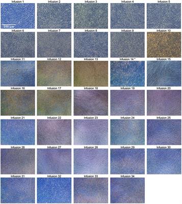 Functional recovery of a 41-year-old quadriplegic spinal cord injury patient following multiple intravenous infusions of autologous adipose-derived mesenchymal stem cells: a case report